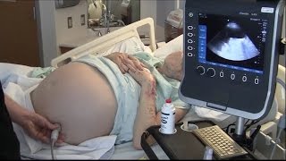 Ultrasound for Paracentesis  BAVLS [upl. by Lyudmila]