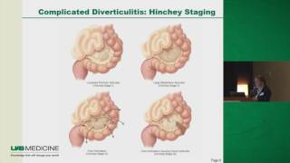 DIVERTICULAR DISEASE How To DIAGNOSE amp TREAT Lower GI Hemorrhage Acute LLQ Pain [upl. by Llyrad]