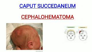 Caput succedaneum and cephalohematoma [upl. by Acacia]