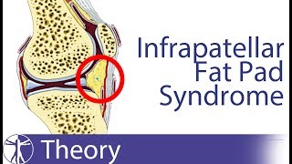 Infrapatellar Fat Pad Syndrome  Hoffas Fat Pad [upl. by Inad509]