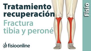 FRACTURA de TIBIA y PERONÉ Rehabilitación ejercicios y tiempo de recuperación [upl. by Athelstan]