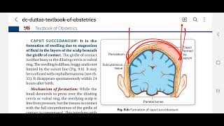 Caput succedaneum in Hindi [upl. by Mclyman]