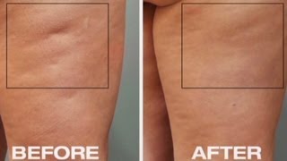 New tool to fight cellulite [upl. by Addia]