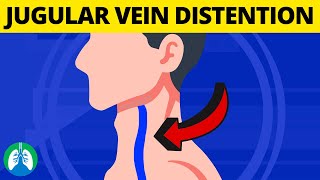 What is Jugular Venous Distention Medical Definition and Explanation [upl. by Nerral663]