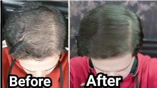 How to Use Rosemary Oil for Hair Growth Baldness Hair Loss Thinning Hair My Results w Pictures [upl. by Lardner]