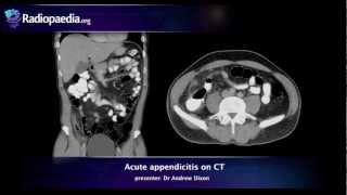 Acute appendicitis on CT  radiology video tutorial [upl. by Yoong]