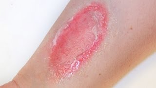 FX MAKEUP SERIES Second Degree Burns [upl. by Jola525]