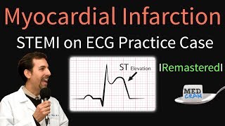 Myocardial Infarction  STEMI on ECG  Practice EKG [upl. by Milla]