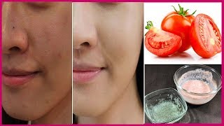 How To Remove Sun Tan in 1 Day  Magical Sun Tan Removal Remedy at Home [upl. by Anirehtak]