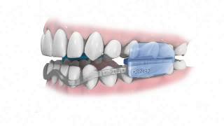 NEW ComfortFit Dental Guard [upl. by Ivel100]