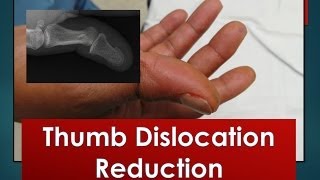 Thumb Dislocation Reduction [upl. by Rimahs]