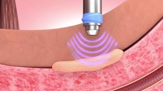 How GAINSWave Solves Peyronies Disease [upl. by Noramac374]