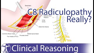 Ulnar Nerve Entrapment mimicking C8 Radiculopathy [upl. by Shornick]