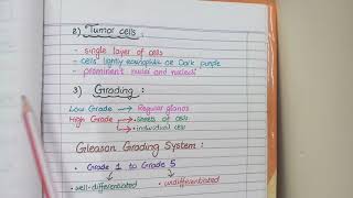 Prostate Carcinoma Pathology  Morphology and Gleason Grading [upl. by Cogn626]