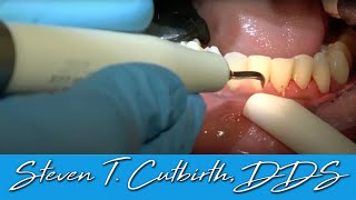 Scaling amp Root Planing  Dental Minute with Steven T Cutbirth DDS [upl. by Nyllaf259]