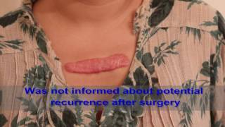 Chest Keloids  Mistakes to Avoid [upl. by Asante]