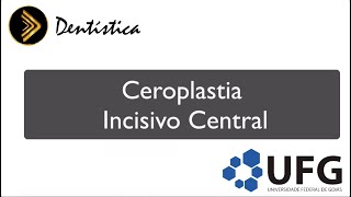 Ceroplastia Incisivo Central Superior [upl. by Rezeile98]