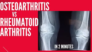 Rheumatoid Arthritis  Signs amp Symptoms  Johns Hopkins Medicine [upl. by Nileve210]