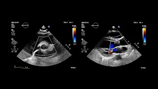 Transcatheter Aortic Valve Implantation TAVI [upl. by Eednahs]