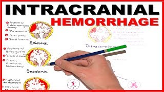 Intracranial Hemorrhage EpiduralSubduralSubarachnoid overview [upl. by Persons]