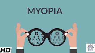 Myopia Signs and Symptoms Causes Diagnosis and Treatment [upl. by Dash]