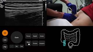 Ultrasound Tutorial AppendixAppendicitis  Radiology Nation [upl. by Yddet946]