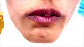 Orofacial Dyskinesia [upl. by Darell]