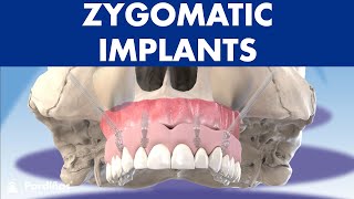 Temporal Approach to elevate and reduce zygomatic arch fracture  maxillofacial surgery  Richardson [upl. by Eitnom734]