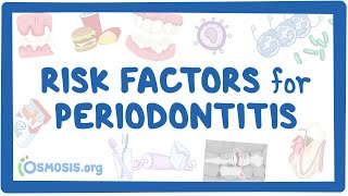 Risk Factors for Periodontitis [upl. by Otsuaf903]