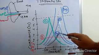 Tympanometry Impedance Audiometry [upl. by Retxed415]