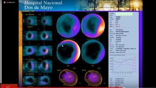 CARDIOLOGÍA NUCLEAR PERFUSIÓN MIOCÁRDICA [upl. by Templas]