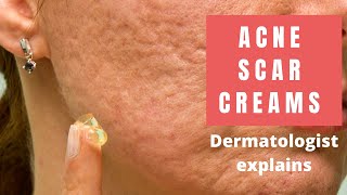 Acne Scar Creams  Dermatologist Reviews [upl. by Leduar330]