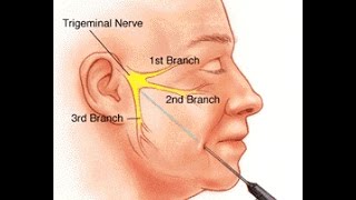 Trigeminal Neuralgia [upl. by Brooking]