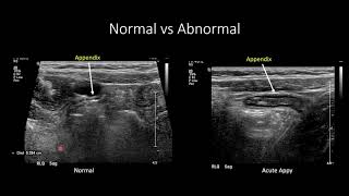 US for Suspected Appendicitis in Children [upl. by Iahk]