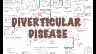 Diverticular Disease diverticulitis  Overview [upl. by Starobin532]