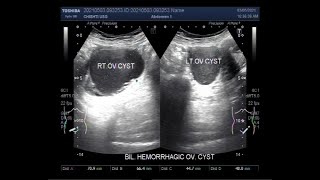 Bilateral Ovarian Cysts Two cases [upl. by Irpak]