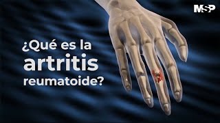 Rheumatoid Arthritis  Treatment  Johns Hopkins [upl. by Einaoj405]