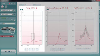 Wideband Tympanometry WBT Tympanograms Tab [upl. by Audley]