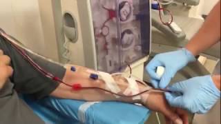 Dialysis connection of a patient with an arteriovenous fistula [upl. by Chavey]