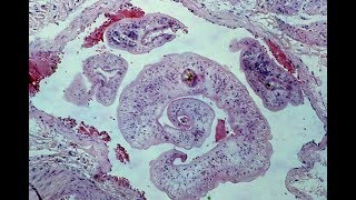 Schistosomiasis  Pathology mini tutorial [upl. by Iru]