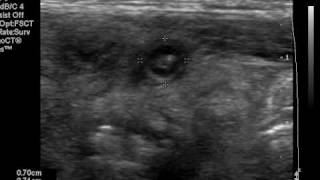 Ultrasound of acute appendicitis [upl. by Amelus]