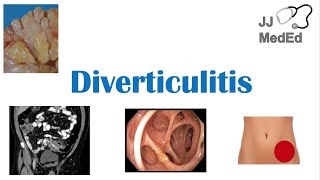 What is diverticulitis Causes symptoms treatment amp more [upl. by Hseham]