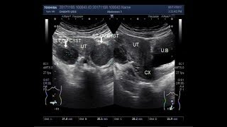 Ultrasound Video showing bilateral ovarian cysts [upl. by Ysnil]