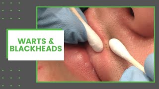 Warts amp Blackheads  Dr Derm [upl. by Apthorp]