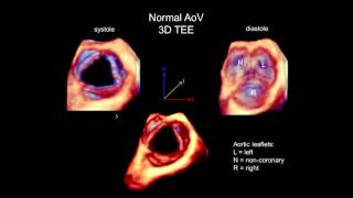 3D Echocardiography Acquisition Cropping and Case Examples [upl. by Noni]