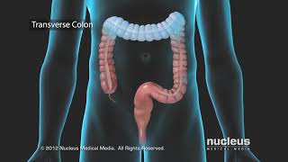 Colon Problems Diverticular Disease [upl. by Annekcm]