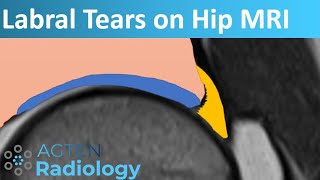 Labral Tears on Hip MRI [upl. by Soraya]