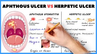 Aphthous ulcer Aphthous stomatitis vs Herpetic ulcer  How to diagnose [upl. by Ahteres221]