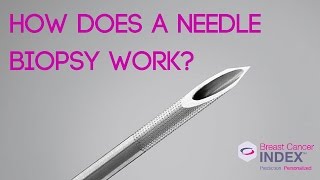 How Does a Needle Biopsy Work [upl. by Retrak]