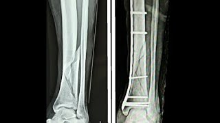 3 Points to remember for successful DISTAL TIBIA PLATING [upl. by Nev]